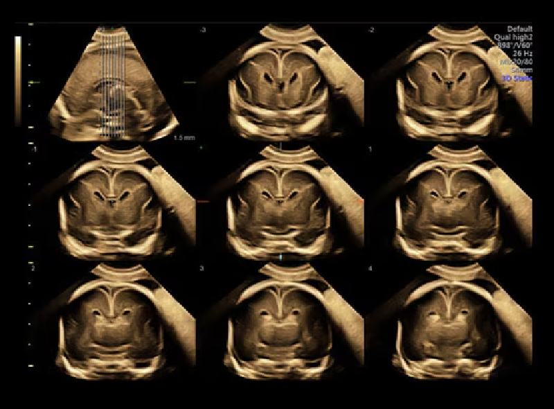 Featured image of post 3D νευροϋπερηχογράφημα