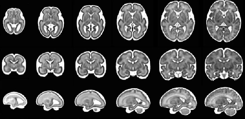 Featured image of post MRI ΚΝΣ εμβρύου